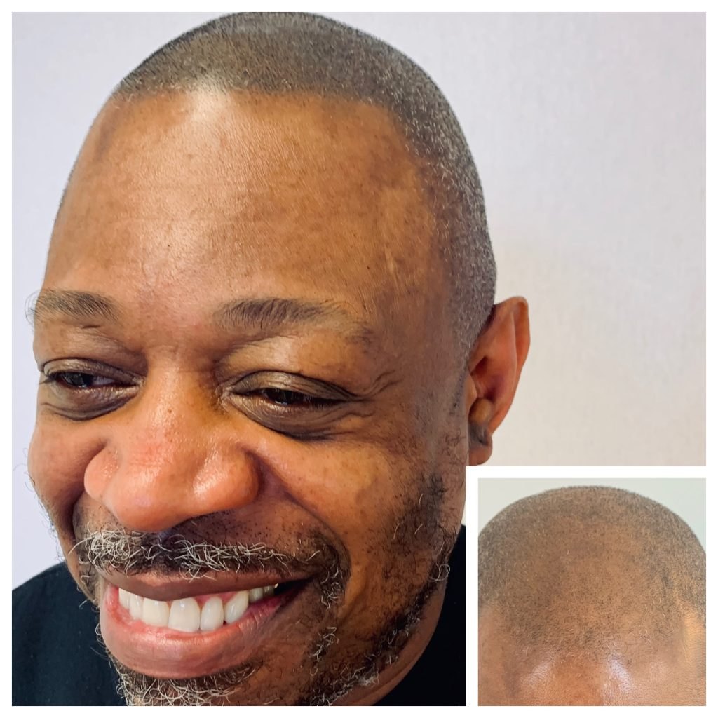 Smiling man with a closely cropped hairline and graying beard, with an inset close-up of his scalp showing short